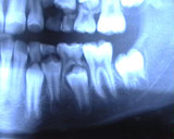 Dents temporaires